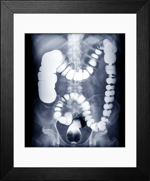 Framed Print : BE or barium enema image or x-ray image of large intestine showing anatomical of colon for detect Colon cancer Framed Print : BE or barium enema image or x-ray image of large intestine showing anatomical of colon for detect Colon cancer