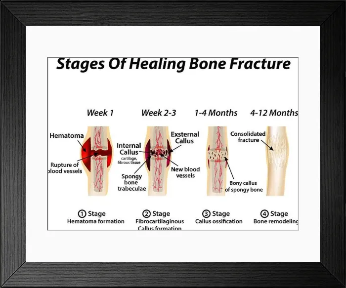 Framed Print : Stages Of Healing Bone Fracture Framed Print : Stages Of Healing Bone Fracture