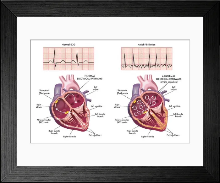 Framed Print : Medical illustration showing the symptoms of a heart with atrial fibrillation compared to normal one Framed Print : Medical illustration showing the symptoms of a heart with atrial fibrillation compared to normal one