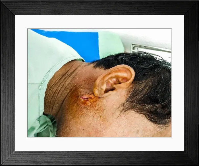 Framed Print : Close up abscess on right face behind the ear of man Framed Print : Close up abscess on right face behind the ear of man