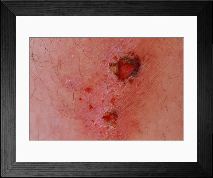 Framed Print : Man with a wound on his knee wound on his leg