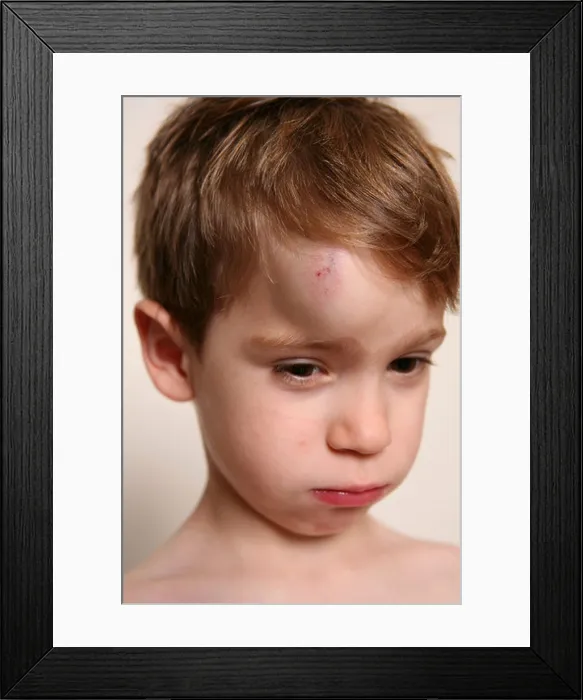Framed Print : CHILD WITH HEMATOMA Framed Print : CHILD WITH HEMATOMA