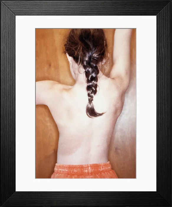 Framed Print : Sprengels deformity Framed Print : Sprengels deformity