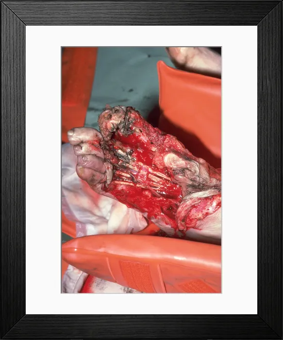 Framed Print : Multiple injuries hit by underground train Framed Print : Multiple injuries hit by underground train