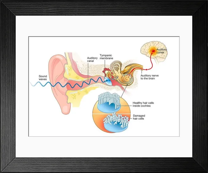 Framed Print : Illustration showing tinnitus. Damaged hair cells inside cochlea, labeled Framed Print : Illustration showing tinnitus. Damaged hair cells inside cochlea, labeled