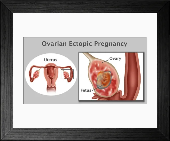 Framed Print : Illustration of an ovarian pregnancy Framed Print : Illustration of an ovarian pregnancy