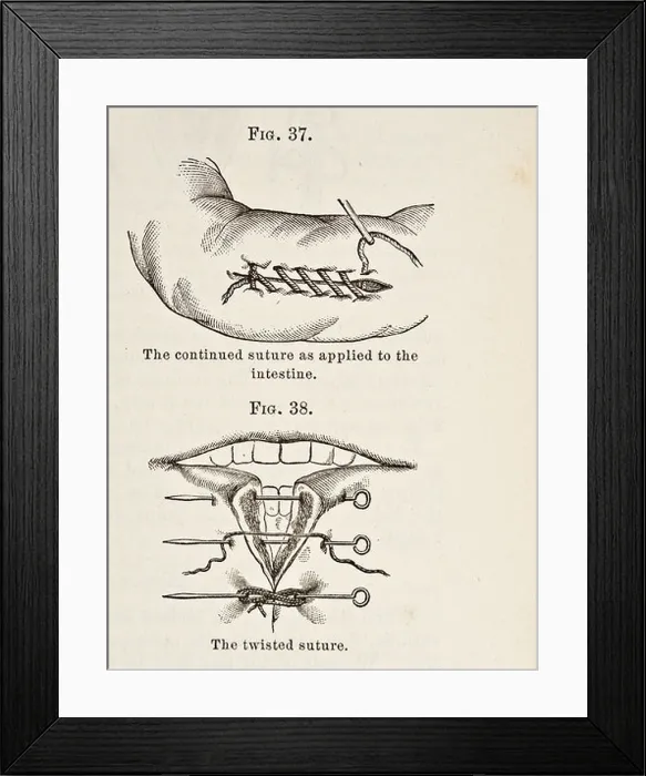 Framed Print : Antique Illustration of Sutures circa 1881 Framed Print : Antique Illustration of Sutures circa 1881