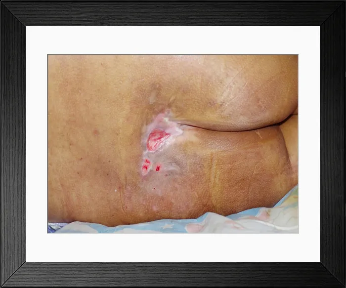 Framed Print : bedsore, pressure sore Framed Print : bedsore, pressure sore