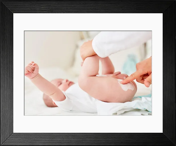 Framed Print : Mother creams the buttocks of an infant as a precaution against intertrigo Framed Print : Mother creams the buttocks of an infant as a precaution against intertrigo