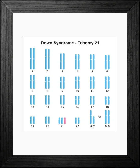 Framed Print : Scientific Designing of Down Syndrome (Trisomy 21) Karyotype. Colorful Symbols. Vector Illustration Framed Print : Scientific Designing of Down Syndrome (Trisomy 21) Karyotype. Colorful Symbols. Vector Illustration