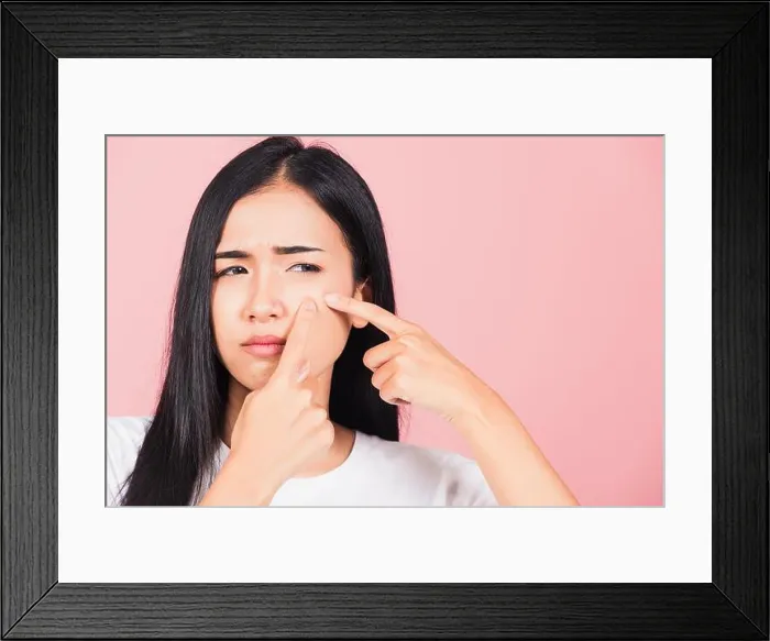 Framed Print : Portrait teenage Asian beautiful young woman having skin problems squeezing pimples on her face Framed Print : Portrait teenage Asian beautiful young woman having skin problems squeezing pimples on her face