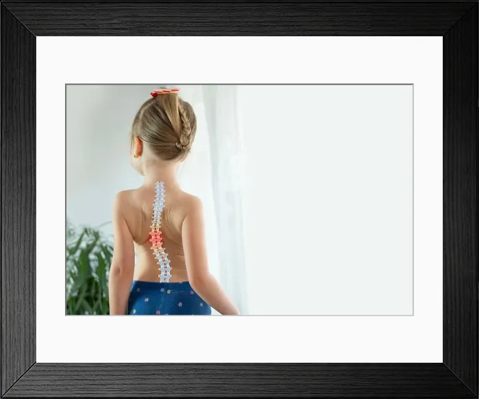 Framed Print : back little girl with scoliosis Framed Print : back little girl with scoliosis