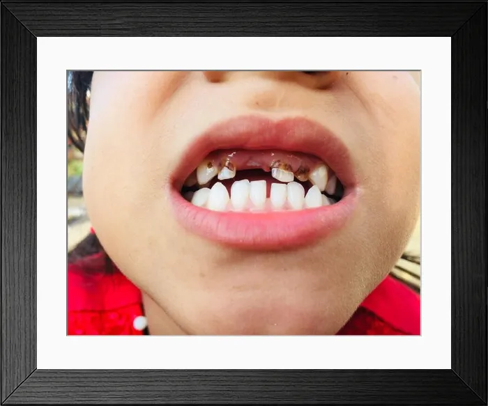 Framed Print : A girl with open mouth showing her teeth for checking her cavity infection and toothache