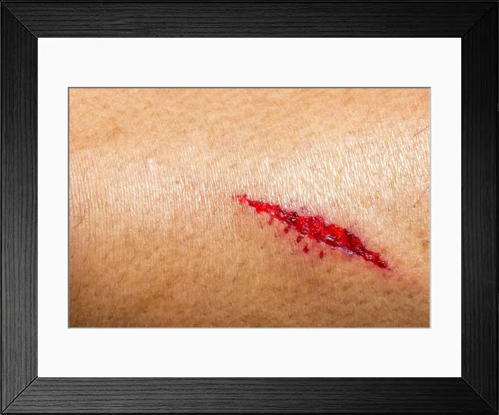 Framed Print : Closeup deep wounds from sharp objects on human skin Framed Print : Closeup deep wounds from sharp objects on human skin