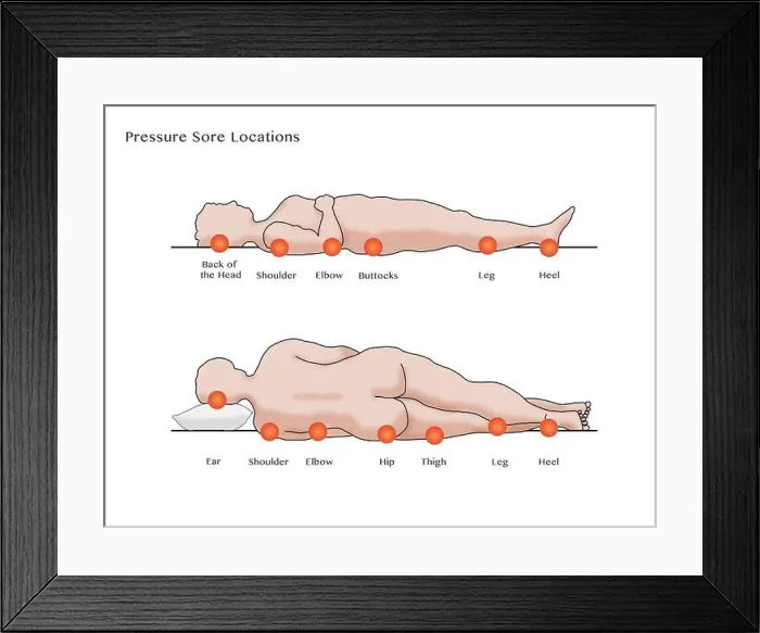 Framed Print : Pressure Sore Locations, Diagram Framed Print : Pressure Sore Locations, Diagram