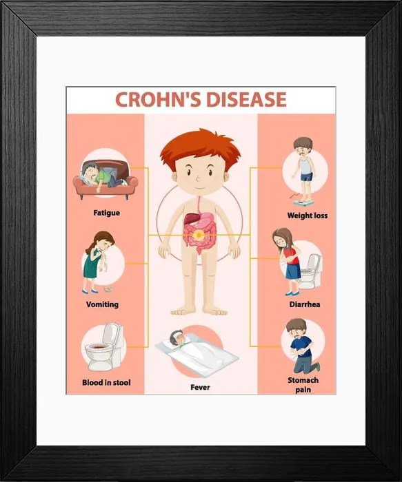 Framed Print : Medical infographic of Crohn's Disease illustration Framed Print : Medical infographic of Crohn's Disease illustration