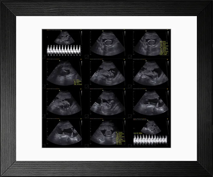 Framed Print : Normal obstetrical ultrasound including Döppler Framed Print : Normal obstetrical ultrasound including Döppler