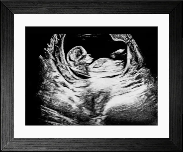 Framed Print : Detailed ultrasound scan showing a fetus in early pregnancy stage Framed Print : Detailed ultrasound scan showing a fetus in early pregnancy stage
