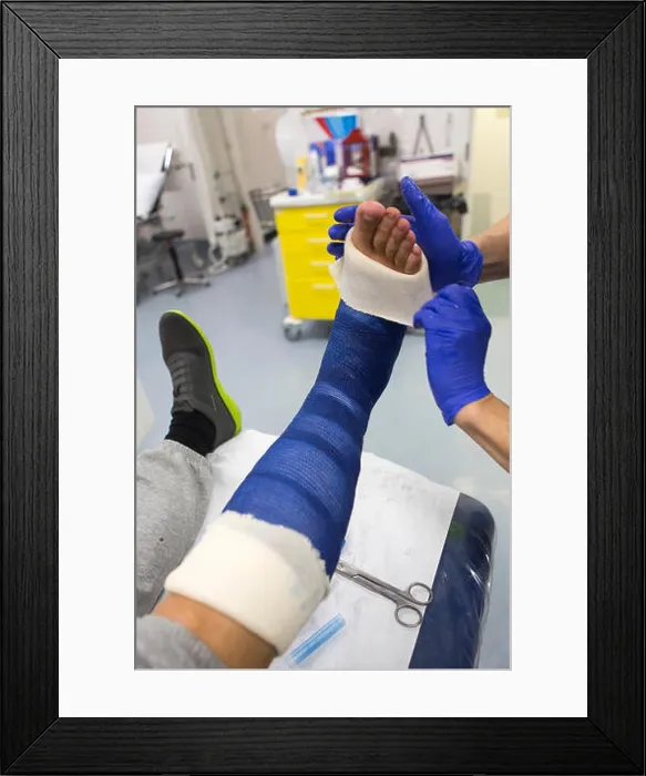 Framed Print : plaster cast on a fractured leg Framed Print : plaster cast on a fractured leg