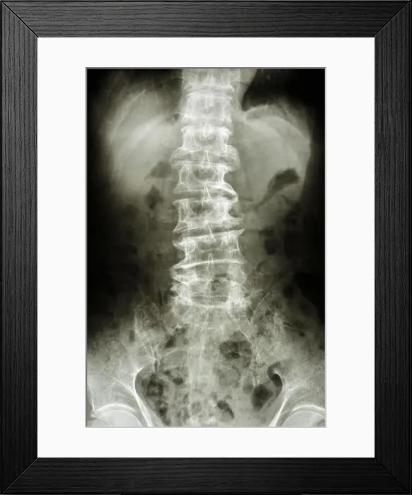 Framed Print : film X-ray show bent lumbar spine and spurs of old people (spondylosis patient), (spine ) Framed Print : film X-ray show bent lumbar spine and spurs of old people (spondylosis patient), (spine )