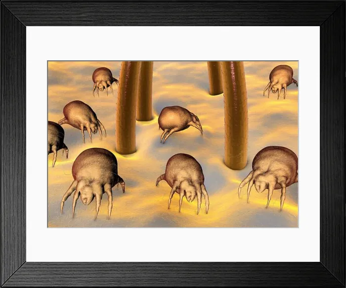 Framed Print : Dust mites (Dermatophagoides pteronyssinus) on human skin Framed Print : Dust mites (Dermatophagoides pteronyssinus) on human skin