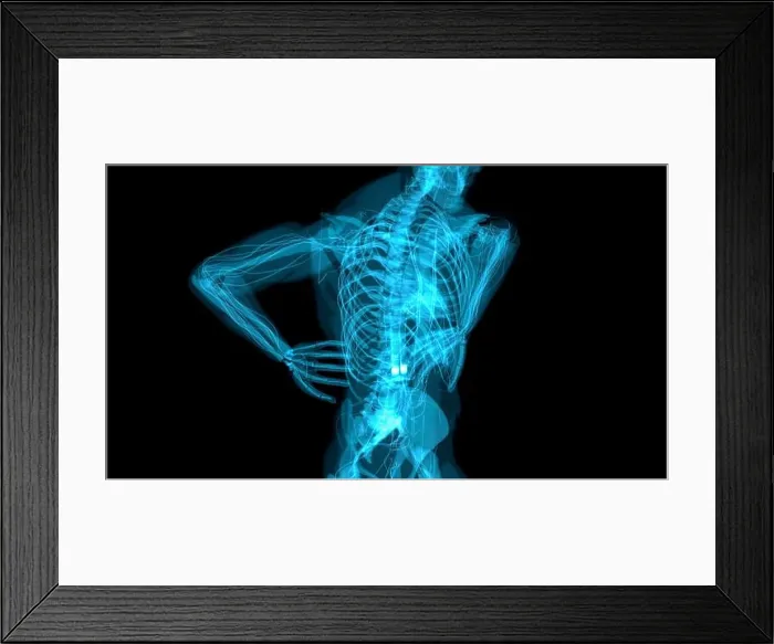 Framed Print : Back pain, conceptual illustration Framed Print : Back pain, conceptual illustration