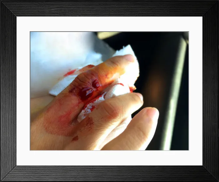 Framed Print : Soft focus the wound was bleeding after a broken glass Framed Print : Soft focus the wound was bleeding after a broken glass