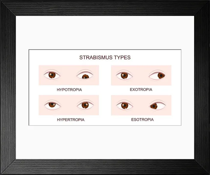 Framed Print : Strabismus types. Hypotropia, hypertropia Framed Print : Strabismus types. Hypotropia, hypertropia
