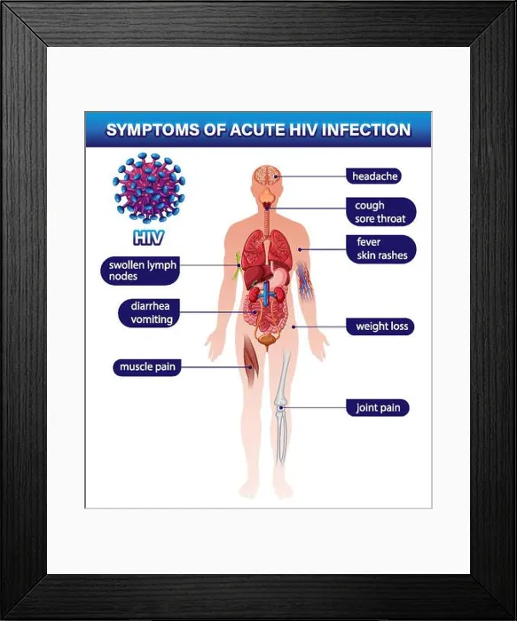 Framed Print : Symptoms of acute HIV infection illustration Framed Print : Symptoms of acute HIV infection illustration