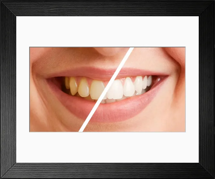 Framed Print : Comparison of teeth of a young woman before and after a tooth cleaning