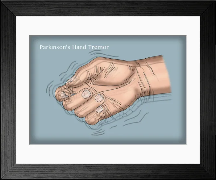Framed Print : Illustration of a hand tremor, one of the symptoms of Parkinson's disease Framed Print : Illustration of a hand tremor, one of the symptoms of Parkinson's disease