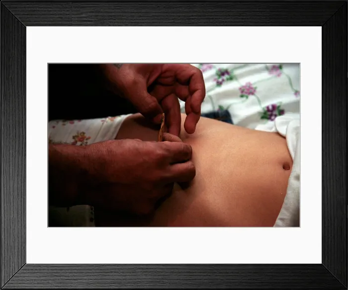Framed Print : The circumcision Master is cutting the foreskin using special knife Framed Print : The circumcision Master is cutting the foreskin using special knife