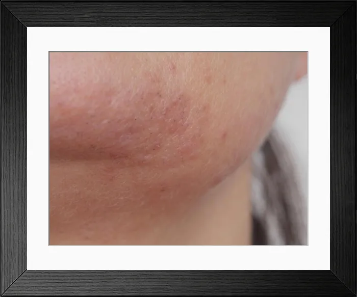 Framed Print : bad skin close-up Framed Print : bad skin close-up