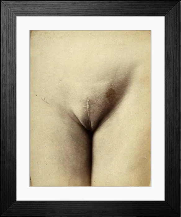 Framed Print : Cosmetic surgery: post-operative stage: a woman's pubes Framed Print : Cosmetic surgery: post-operative stage: a woman's pubes