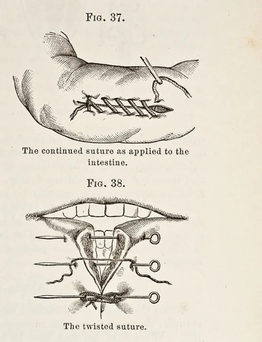 Framed Print : Antique Illustration of Sutures circa 1881 Framed Print : Antique Illustration of Sutures circa 1881