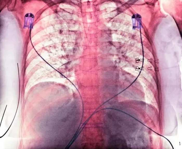 Framed Print : Aspiration. Coloured chest X-ray showing aspiration (dark areas) Framed Print : Aspiration. Coloured chest X-ray showing aspiration (dark areas)
