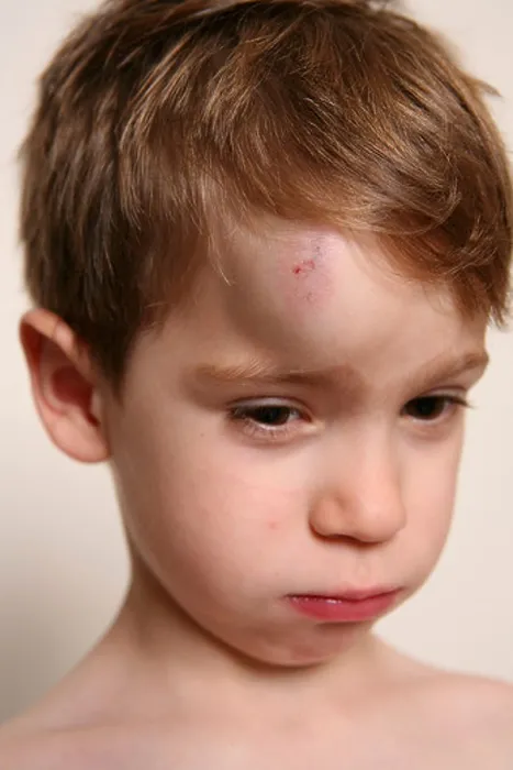 Framed Print : CHILD WITH HEMATOMA Framed Print : CHILD WITH HEMATOMA