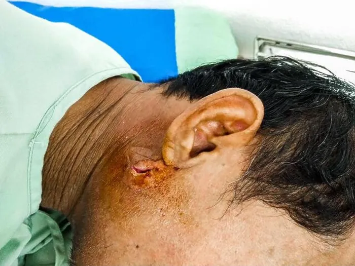 Framed Print : Close up abscess on right face behind the ear of man Framed Print : Close up abscess on right face behind the ear of man