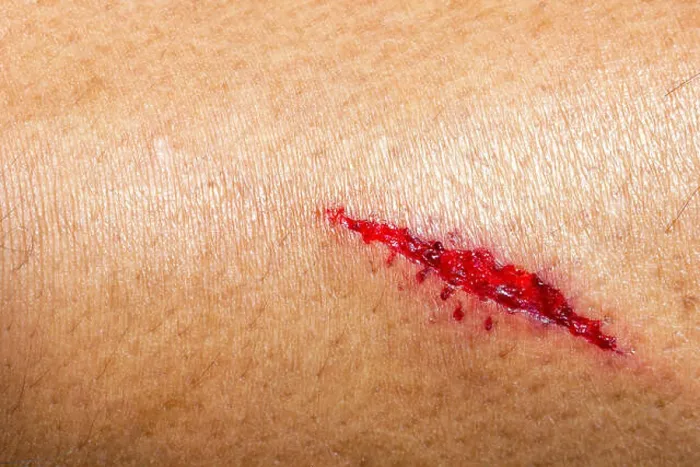 Framed Print : Closeup deep wounds from sharp objects on human skin Framed Print : Closeup deep wounds from sharp objects on human skin
