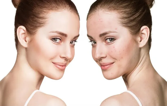 Framed Print : Comparison portrait of young girl with problematic skin before and after treatment Framed Print : Comparison portrait of young girl with problematic skin before and after treatment