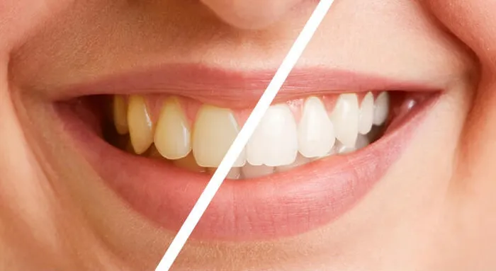 Framed Print : Comparison of teeth of a young woman before and after a tooth cleaning