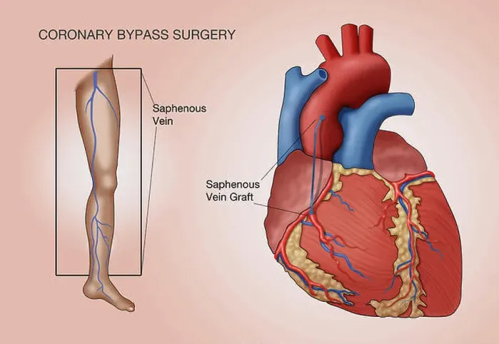 Framed Print : Coronary bypass surgery, labeled illustration Framed Print : Coronary bypass surgery, labeled illustration