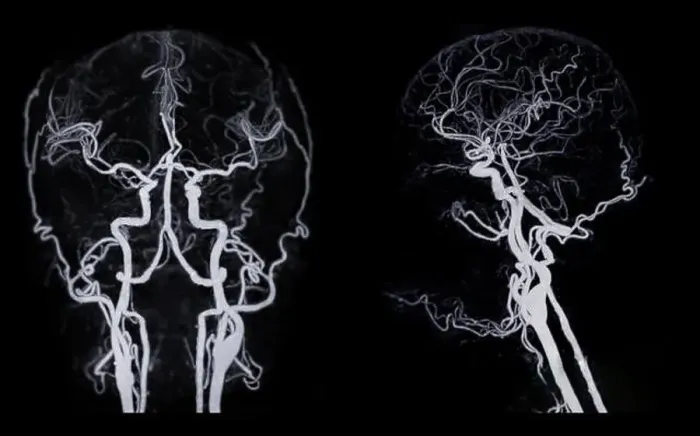 Framed Print : CT angiography of the brain or CTA brain showing Cerebral artery