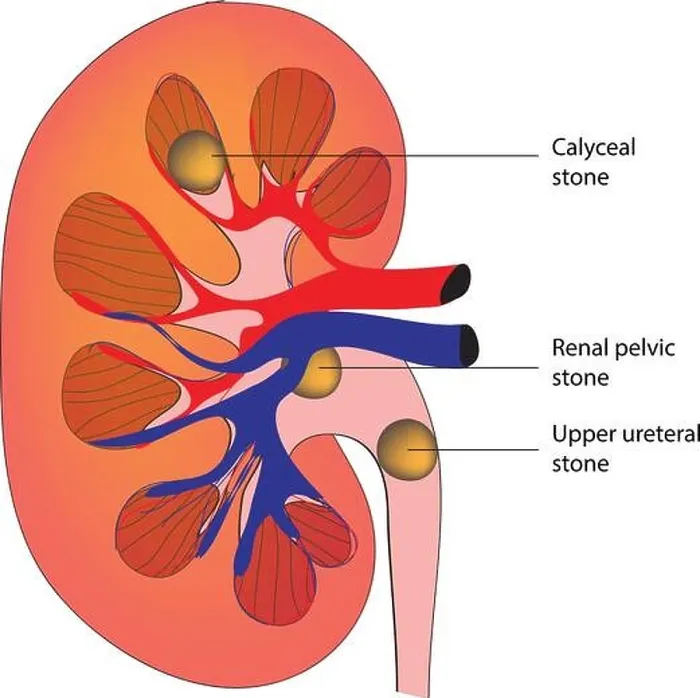 Framed Print : Detailed diagram of kidney stone Framed Print : Detailed diagram of kidney stone