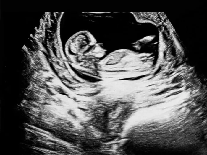 Framed Print : Detailed ultrasound scan showing a fetus in early pregnancy stage Framed Print : Detailed ultrasound scan showing a fetus in early pregnancy stage