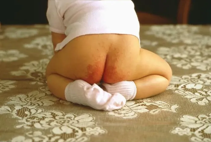 Framed Print : Diaper erythema Framed Print : Diaper erythema