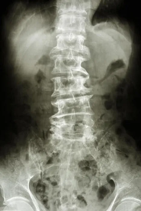 Framed Print : film X-ray show bent lumbar spine and spurs of old people (spondylosis patient), (spine ) Framed Print : film X-ray show bent lumbar spine and spurs of old people (spondylosis patient), (spine )