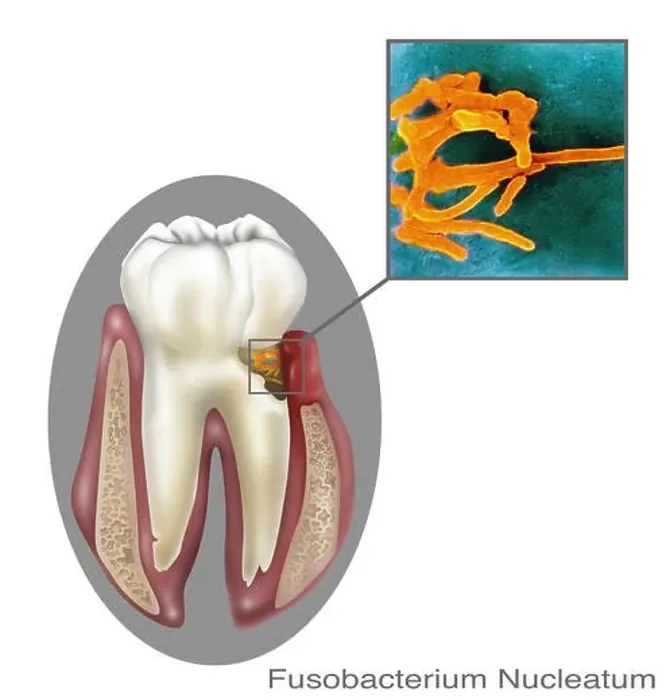 Framed Print : Fusobacterium nucleatum, oral bacteria found in the dental plaque of humans Framed Print : Fusobacterium nucleatum, oral bacteria found in the dental plaque of humans