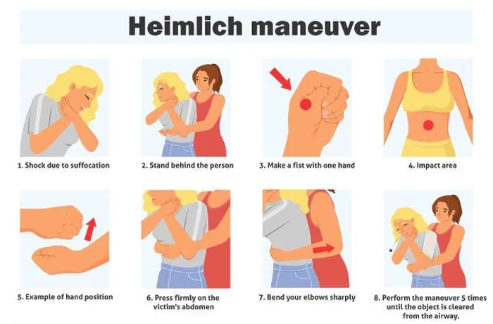 Framed Print : Heimlich maneuver infographic poster with steps of first aid Framed Print : Heimlich maneuver infographic poster with steps of first aid