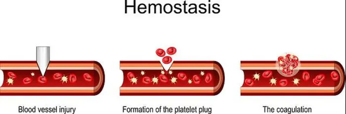 Framed Print : Hemostasis. Cross section of a Blood Vessel after injury Framed Print : Hemostasis. Cross section of a Blood Vessel after injury